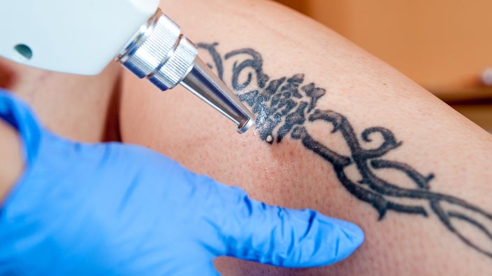 Close-up on a person getting their tattoo removed with a laser removal device.
