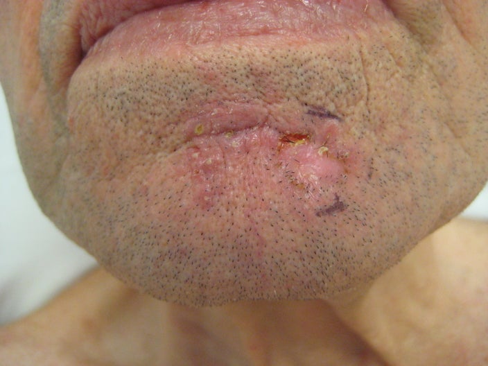 Close-up of a morpheaform basal cell carcinoma on the chin. 