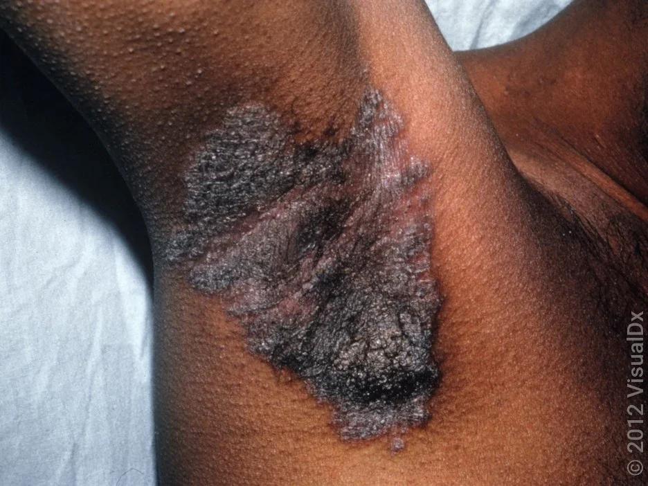 Close-up of an armpit with thick, dark brown, scaly patch in inverse psoriasis. 