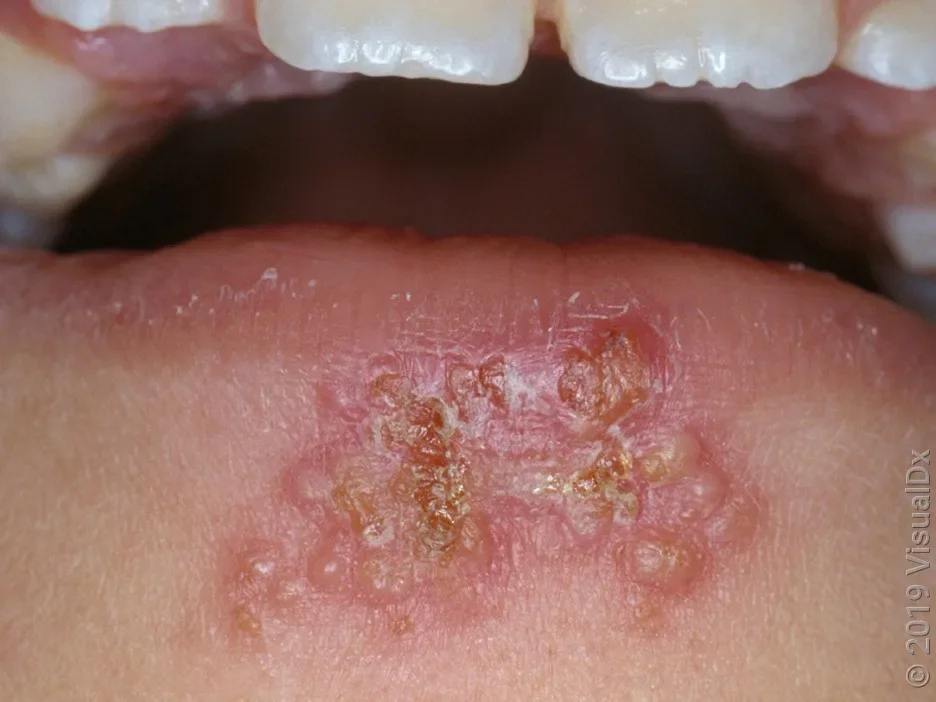 Close-up of a cluster of blisters on the lower lip from a herpes cold sore.