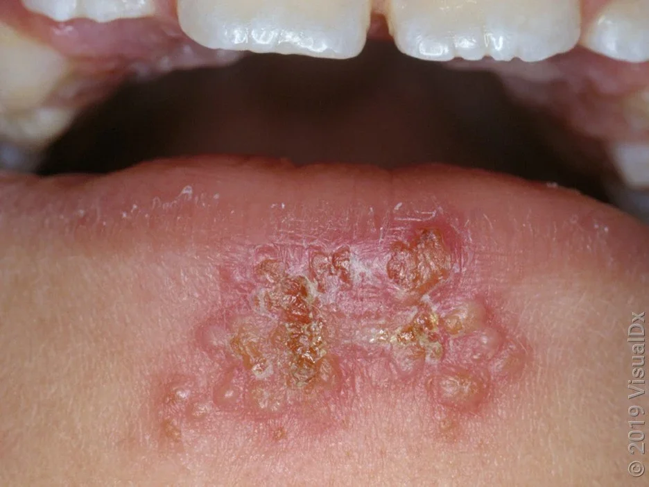 Close-up of a cluster of blisters on the lower lip from a herpes cold sore.