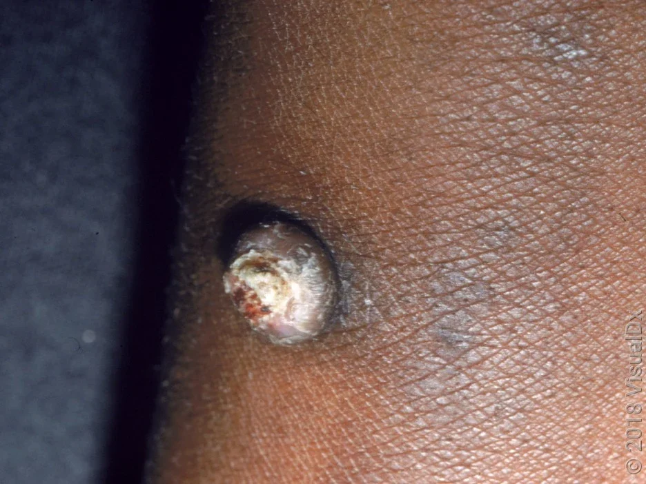Close-up of a squamous cell carcinoma on dark skin. 