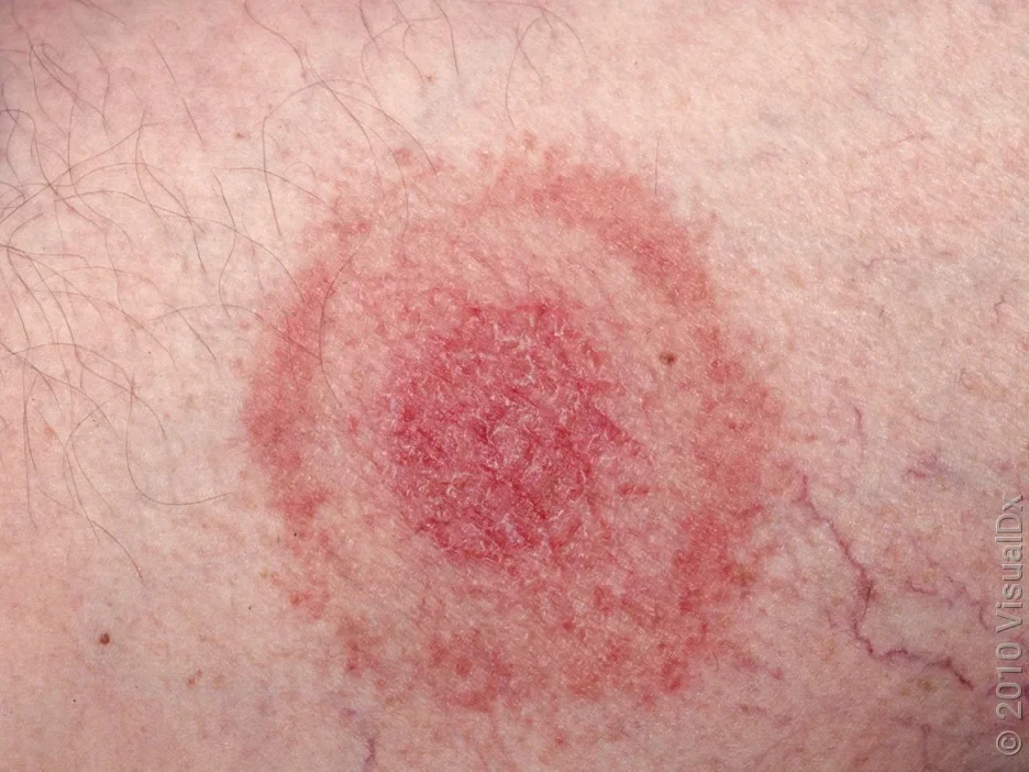 Close-up of bulls-eye rash on the skin, from Lyme disease. 