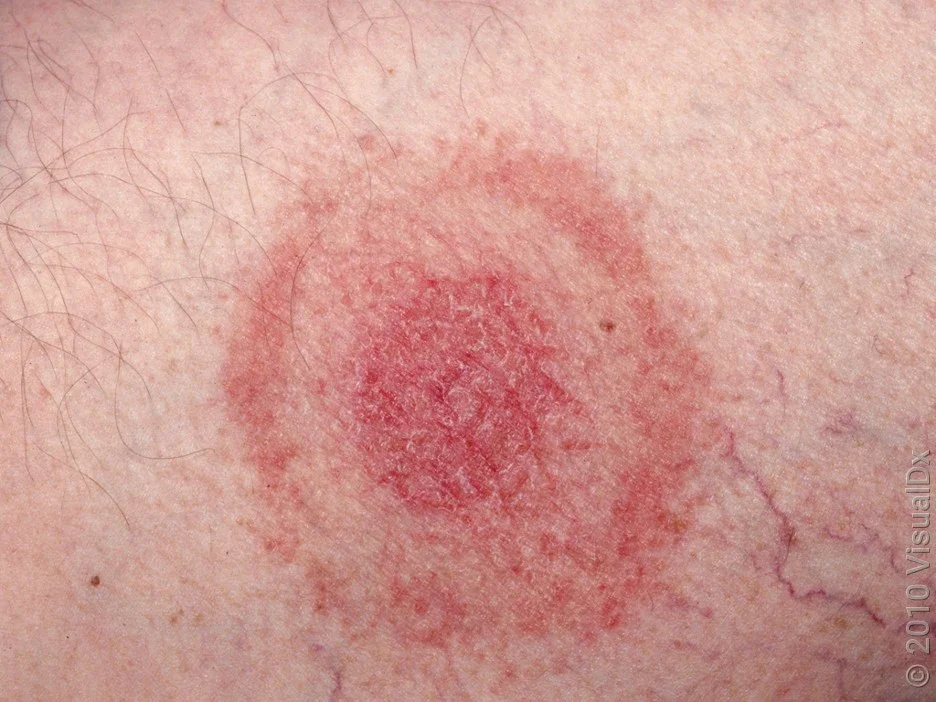 Close-up of bulls-eye rash on the skin, from Lyme disease. 