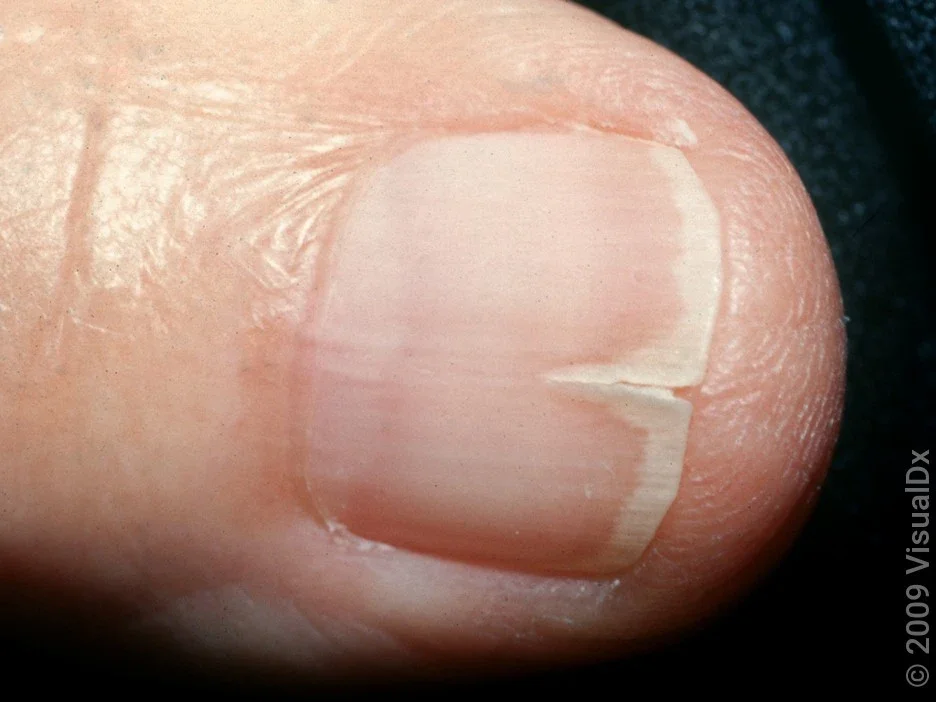 A vertical fingernail split. 