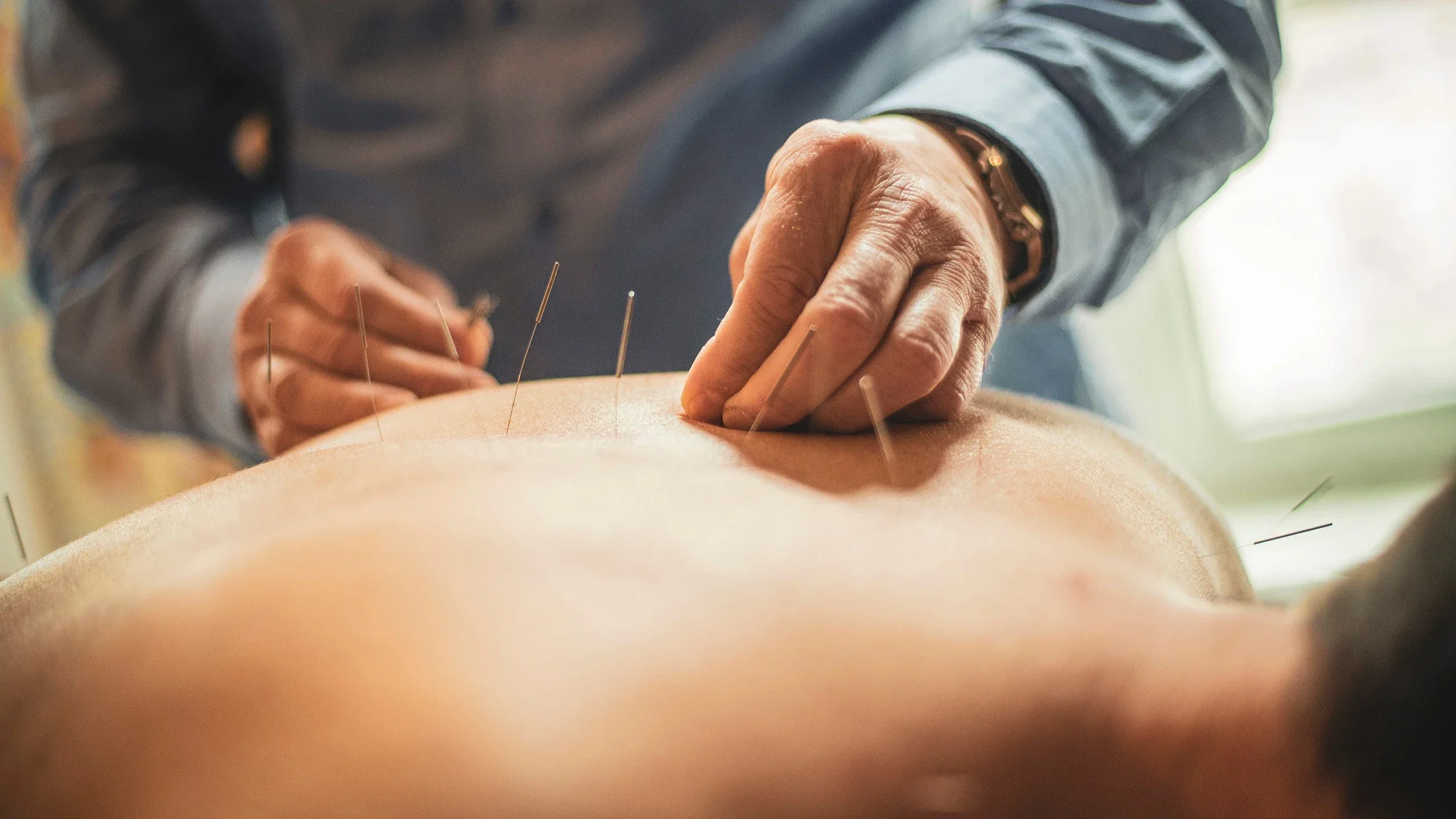 Close-up of an acupuncturist giving treatment to a patient. There are acupuncture needles along the person's back.
LukaTDB/iStock via Getty Images