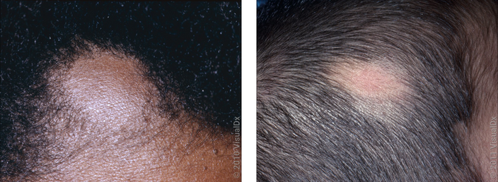 Left: Close-up of a round patch of hair loss in alopecia areata. Right: Close-up of an oval patch of hair loss in alopecia areata. 