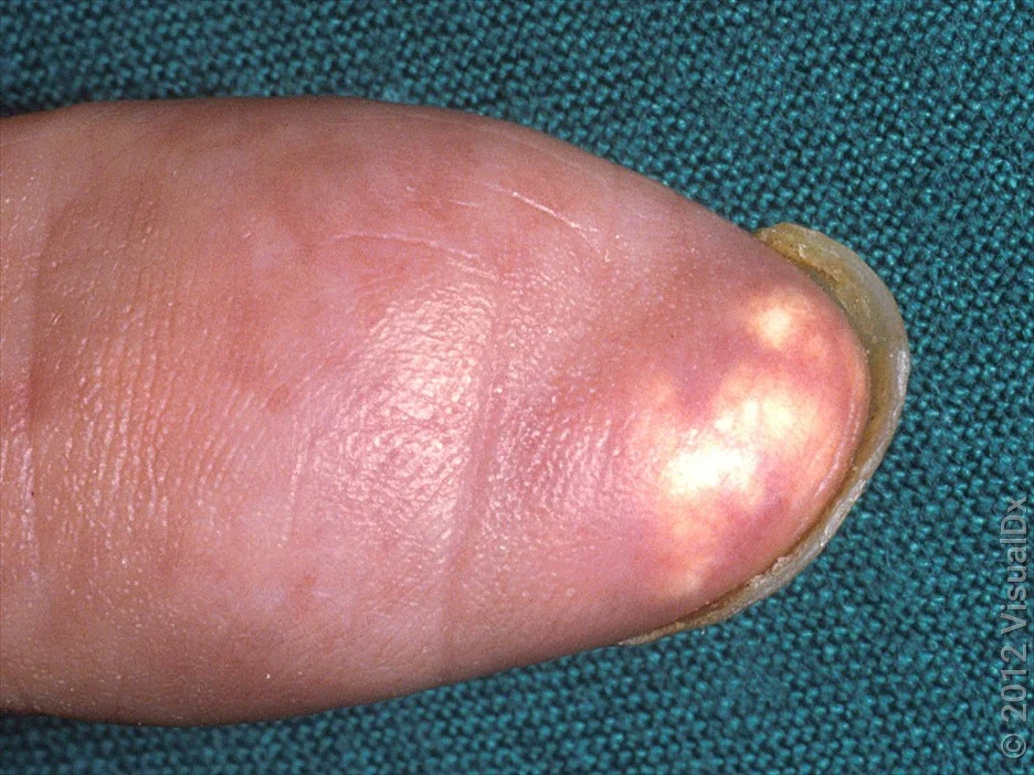 Small yellow-white bumps caused by gout.
