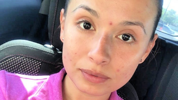 Photo of Tammi with acne scars