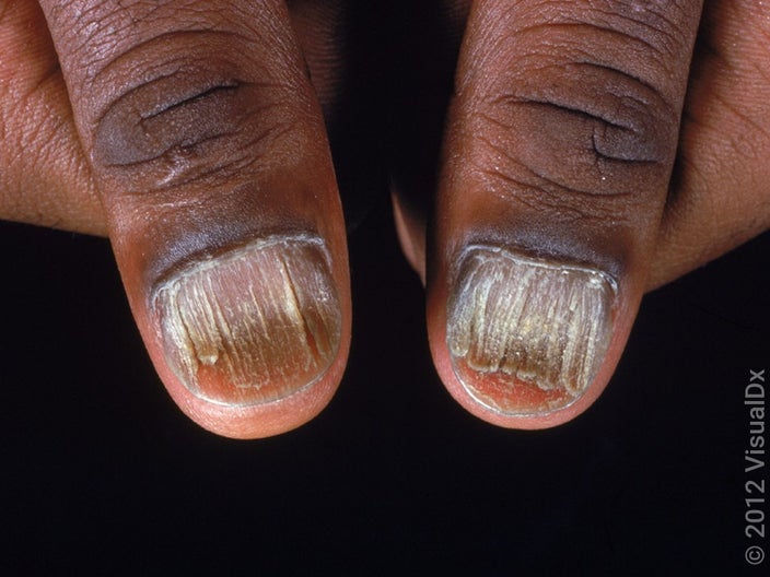 Close-up of shortened nails that are rough and splitting with long ridges (nail psoriasis).