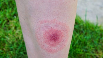 lyme-disease-symptoms.jpg