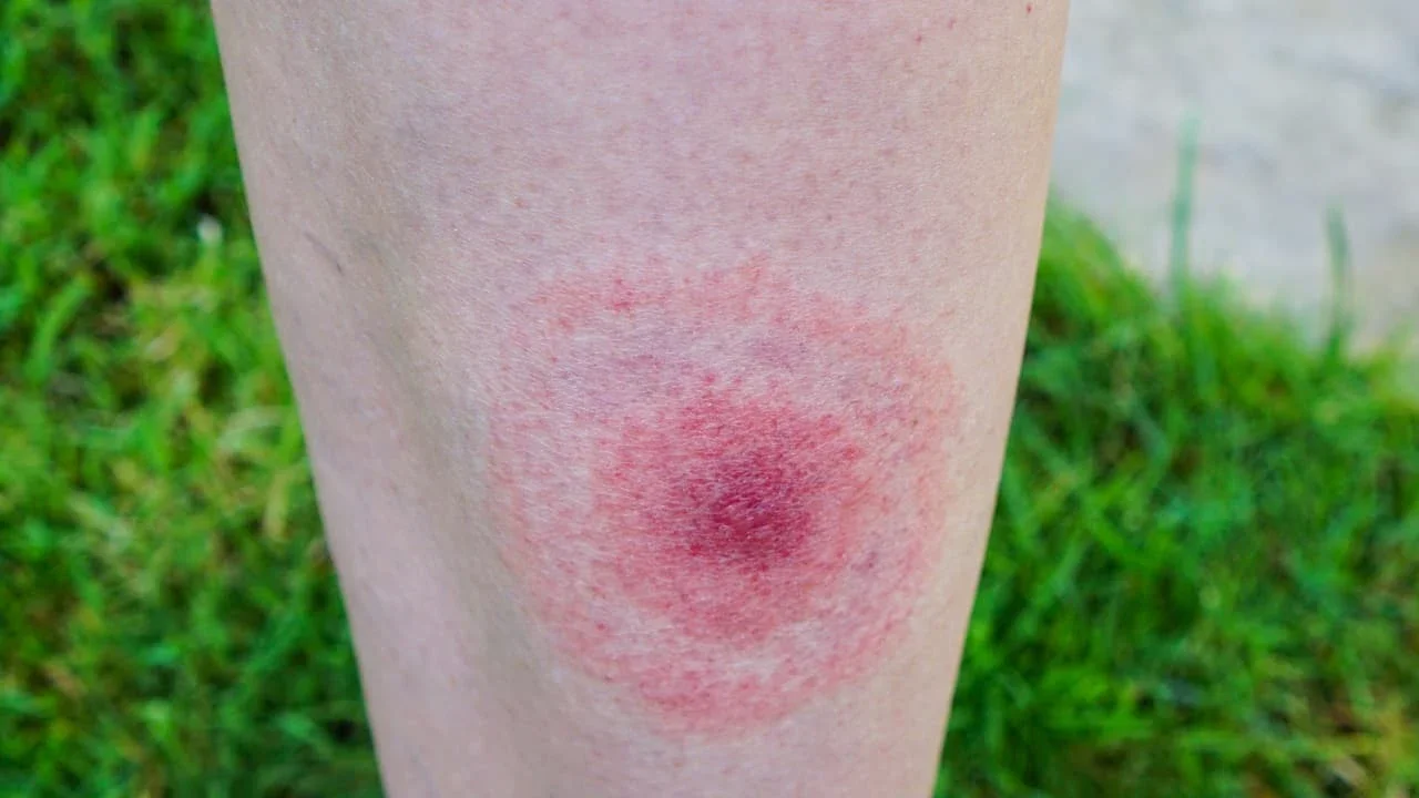 lyme-disease-symptoms.jpg
