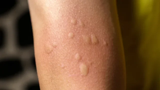 Hives: closeup arm with hives 1483221343