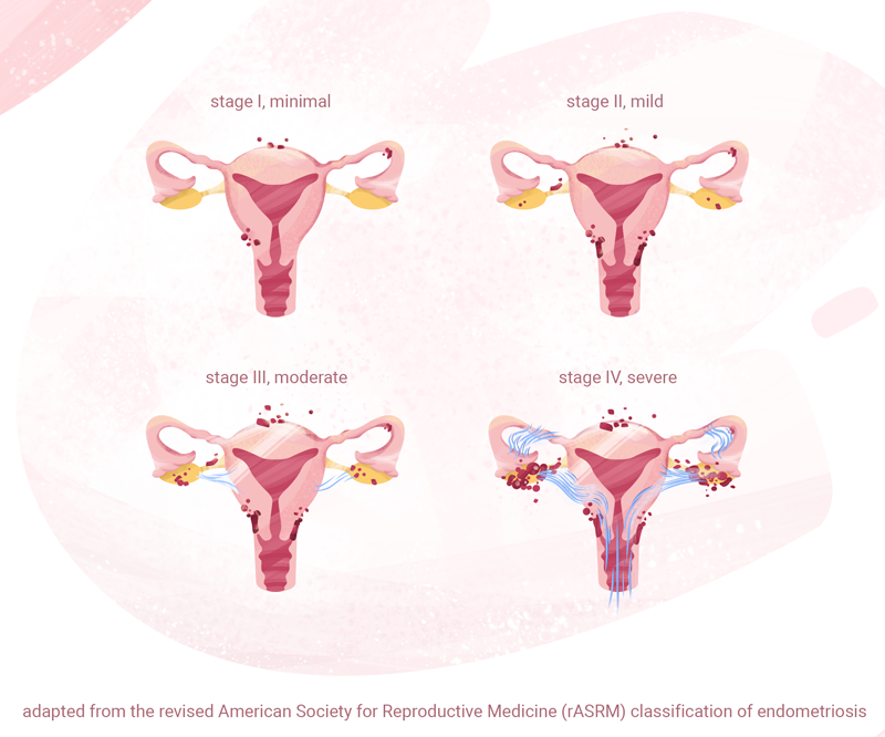 Uterus diagrams showing the four stages of endometriosis: Stage I minimal, Stage II mild, Stage III moderate, Stage IV severe.