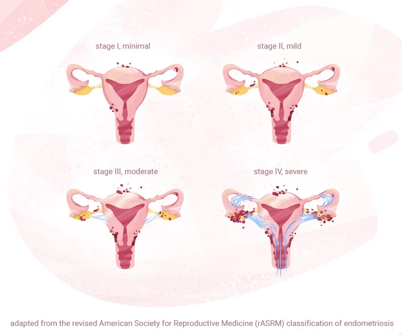 Stages of endometriosis: Mobile