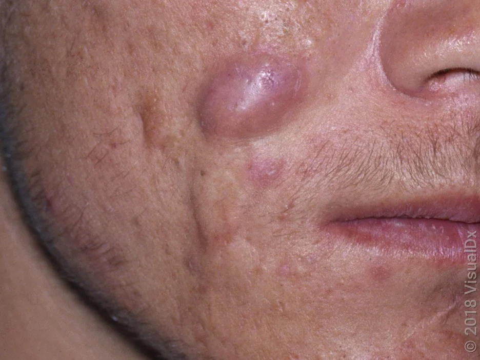Close-up of a large acne cyst on the cheek. 