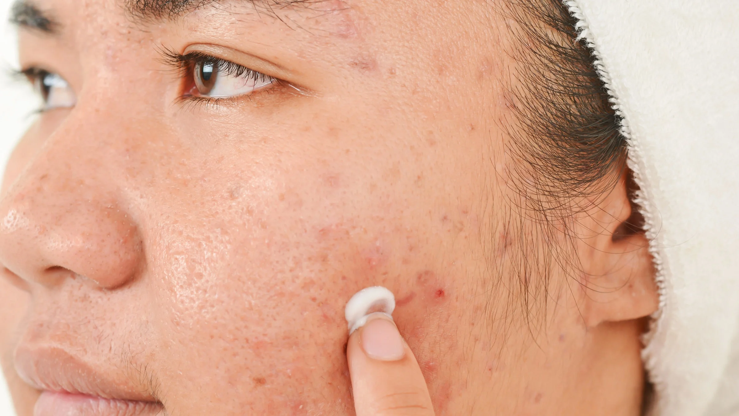 A close-up of someone applying cream on a pimple.