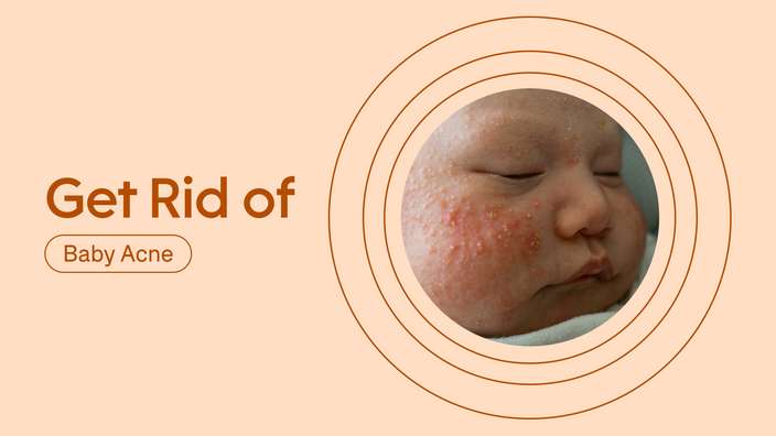 How To Get Rid of Baby Acne? 3 Moms What Worked - GoodRx