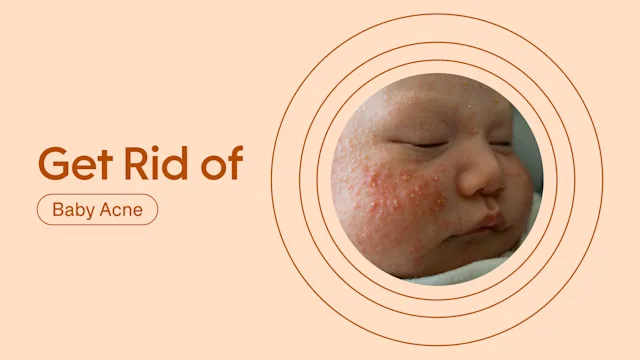 Health: Patient experiences: rid featured image baby acne
