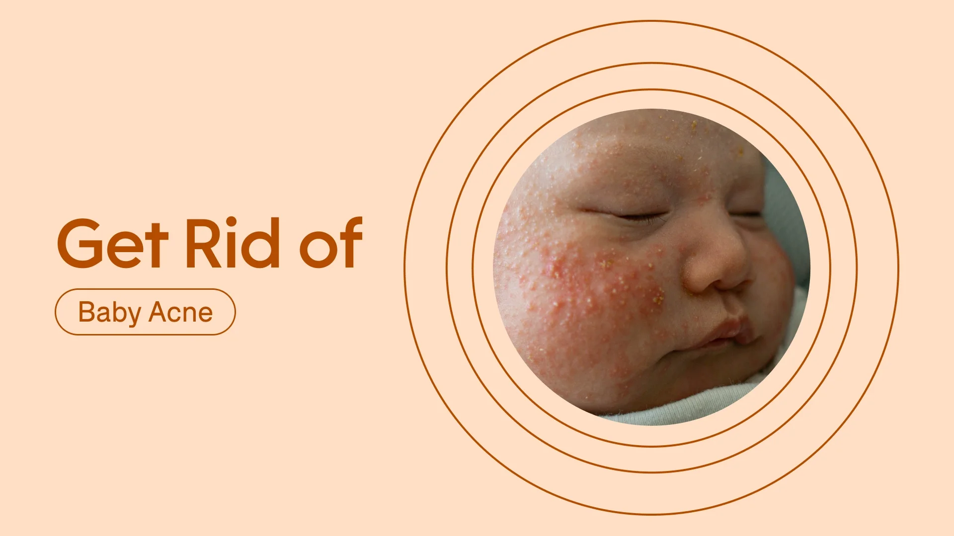 Light reddish orange background with text reading “Get Rid of Baby Acne” on the left hand side. There is a circular photo of an infant with baby acne surrounded by radial red circles.
