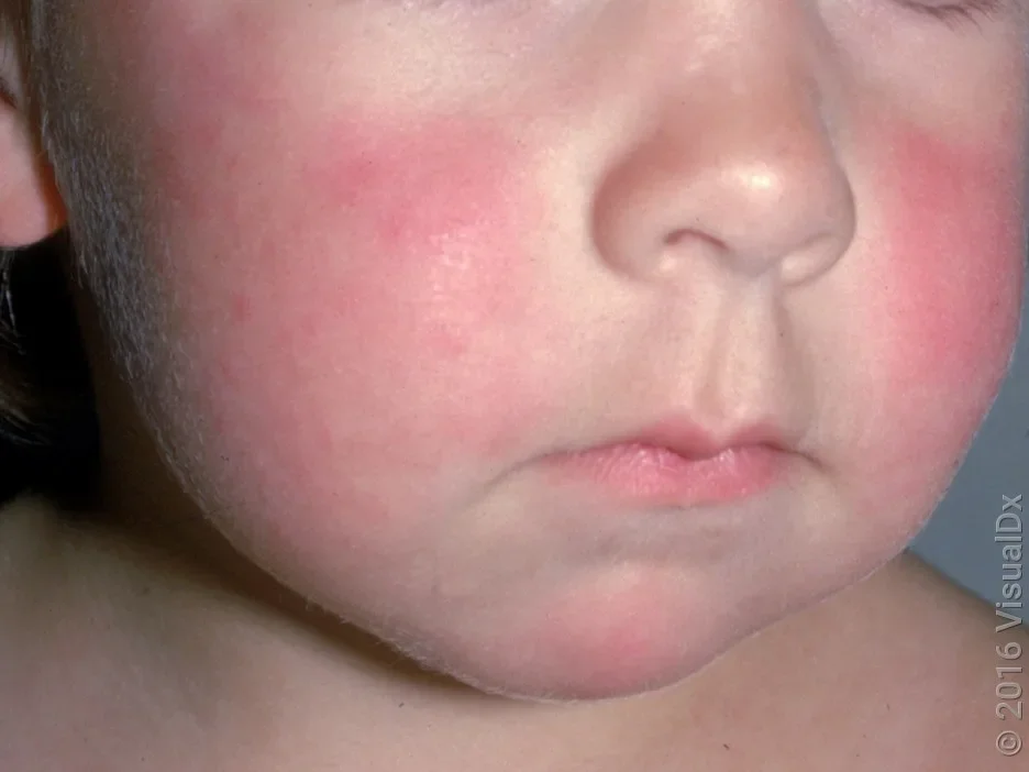 Close-up of fifth disease rash on the cheeks (“slapped cheek”). 