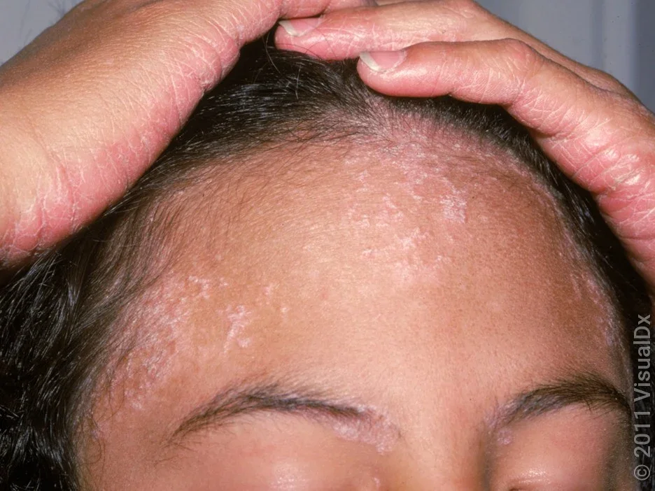 Close-up of a forehead with light pink scaly patches caused by psoriasis. 