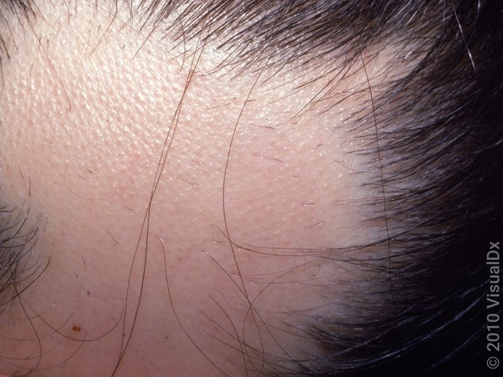 Close-up of alopecia areata hair thinning and loss on the scalp. 