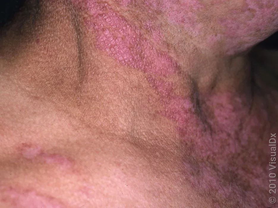 Lupus rash on the neck. 