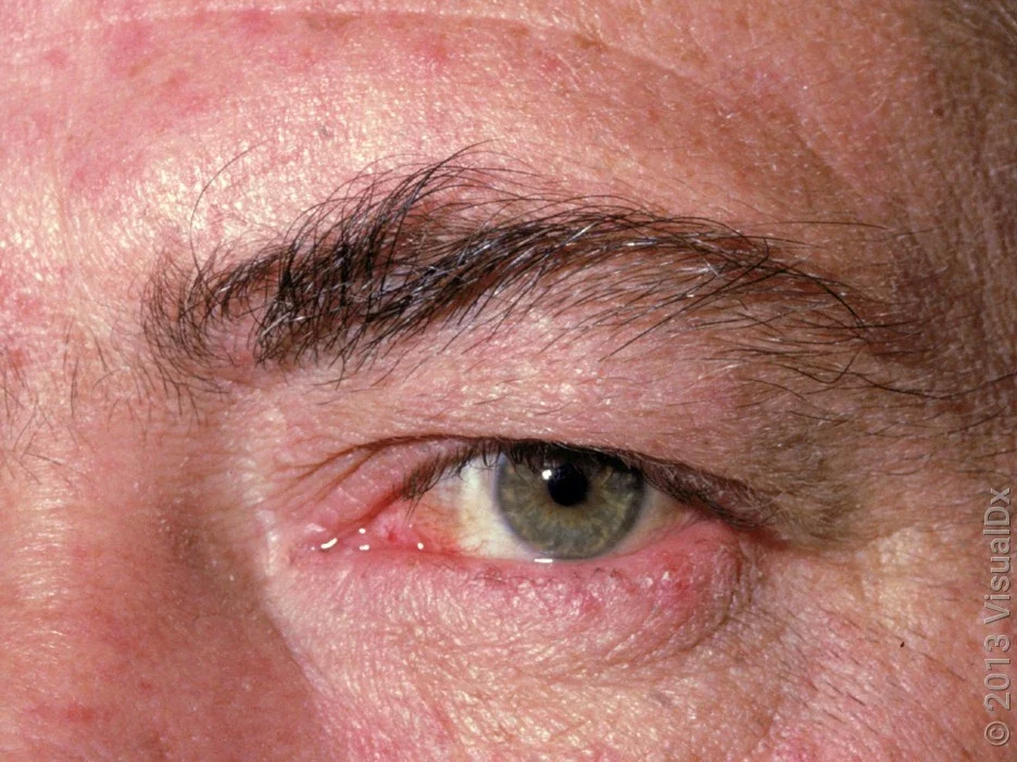Close-up of ocular rosacea.
