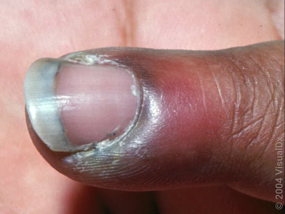 Close-up of finger with red and inflamed skin around the nail in paronychia. 