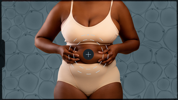 procedures: surgery liposuction-01