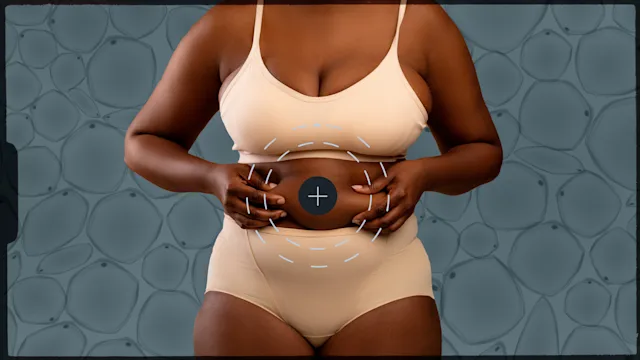 procedures: surgery liposuction-01