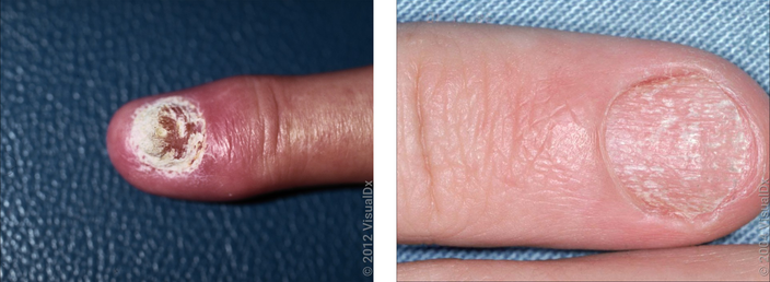 Left: Close-up of finger with crumbly nail. Right: Close up of a crumbly fingernail.