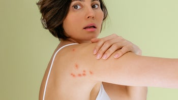 Dermatology: Bug bite: woman with bites on shoulder 2150727664