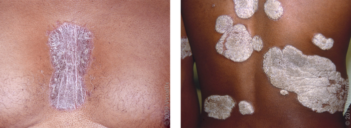 Left: Close up of a darker-skinned chest with a violet patch of skin covered in silver scale (psoriasis).  Right: The back of a person with dark skin showing large, thick white patches (psoriasis). 