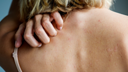 Cropped close-up of a woman scratching her upper back. She has short blonde hair and is wearing a tank top.
Rawpixel/iStock via Getty Images