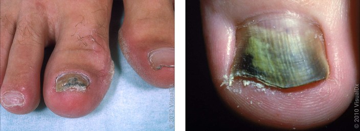 What Is Onychomycosis (Nail Fungus), and What Does It Look Like