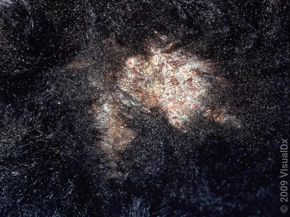 Close-up of scalp ringworm with temporary hair loss.