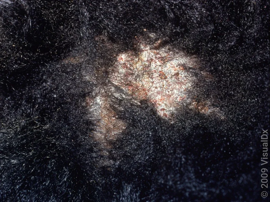 Close-up of scalp ringworm with temporary hair loss. 