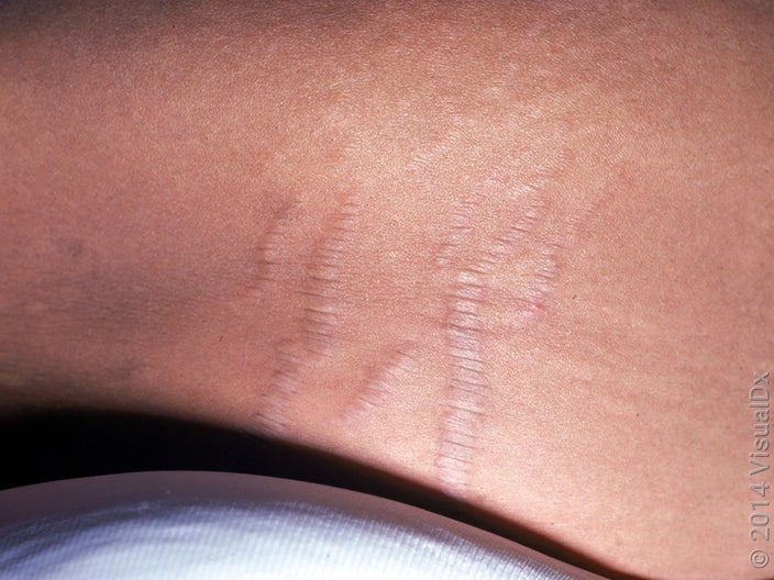 Close-up of leg with older stretch marks. 