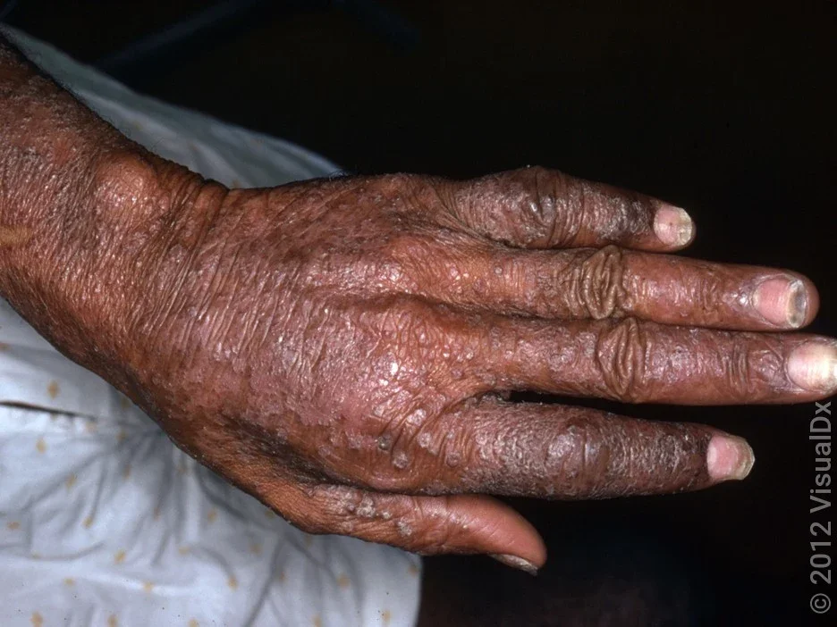 A hand with swollen joints, nail changes, and psoriasis from psoriatic arthritis rash flare.