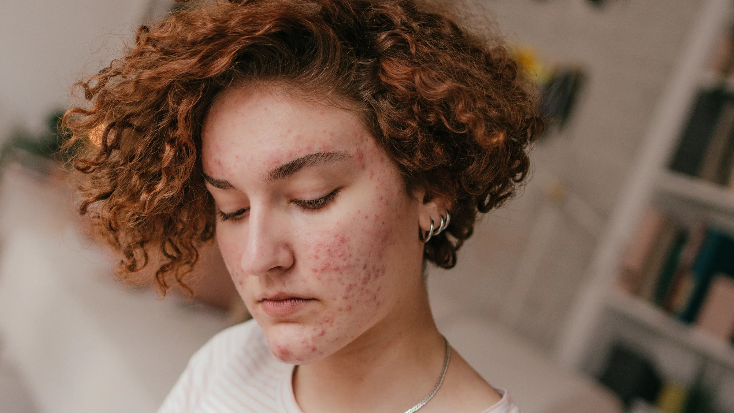 A person with acne looking down.