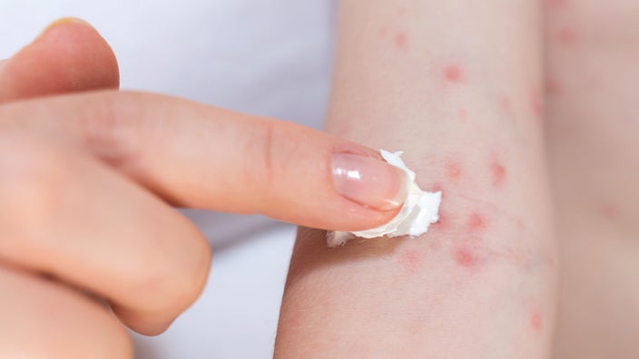 A hand applying cream on an allergic rash.