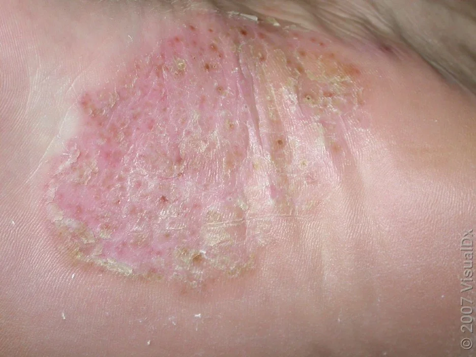 Close-up of pustular psoriasis on the sole of the foot. 