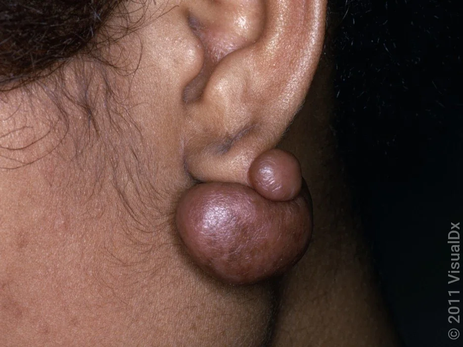 Close-up of an ear with a keloid from a piercing.