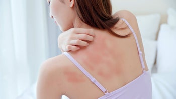 Health: Ibuprofen: woman scratches back rash-1338224833