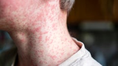 Rubella (German measles) and rubeola (measles) are two different conditions with similar symptoms. Learn how to tell the difference between rubella and rubeola.