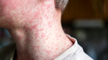 Dermatology: closeup neck with measles rash 2152300024