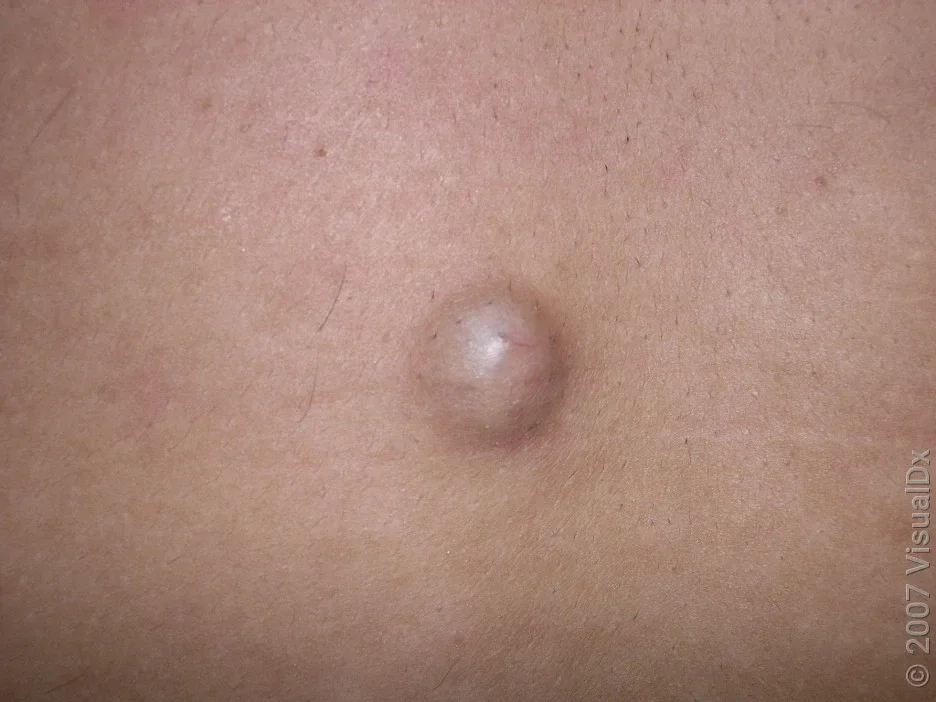 Close-up of a sebaceous cyst on the back. 