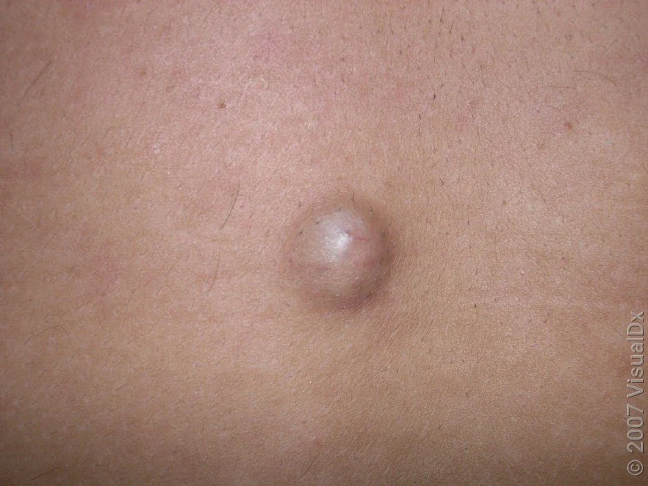 Close-up of a sebaceous cyst on the back. 